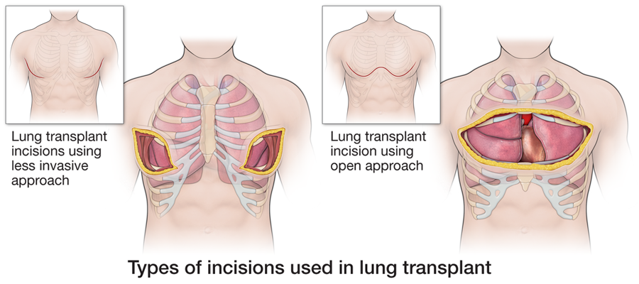 Lung transplant incision types