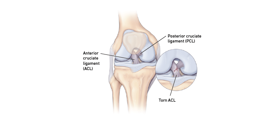 Torn anterior cruciate ligament graphic