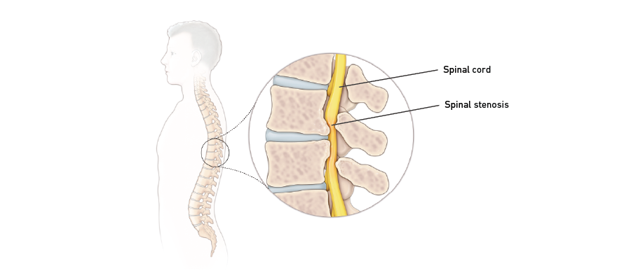 Spinal stenosis graphic