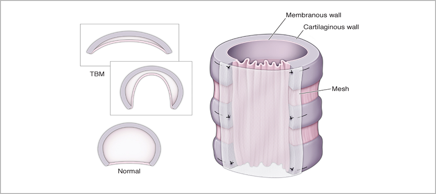 Tracheobronchomalacia vs. normal airway