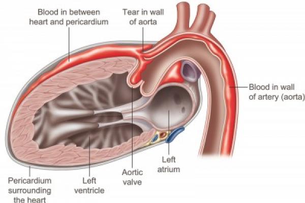 Diagram of an aortic dissection