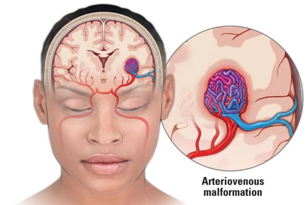 Illustration of arteriovenous malformation