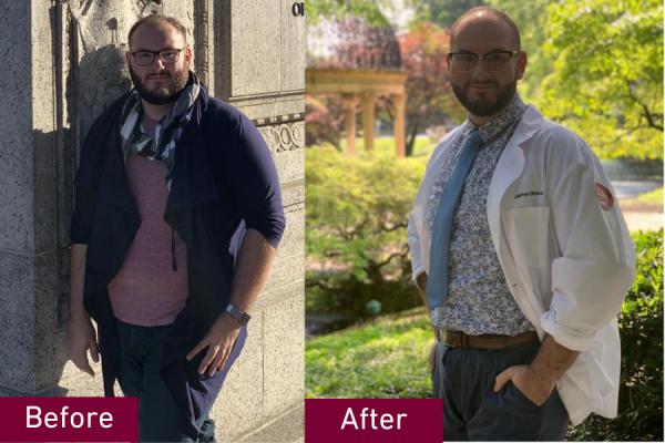 Jimmy before and after bariatric surgery
