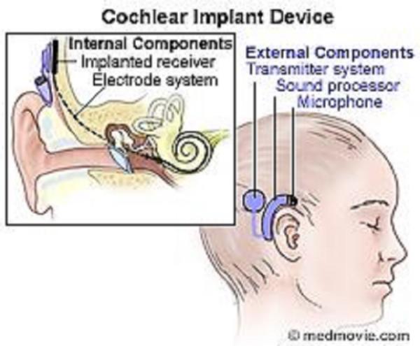 Cochlear implant graphic