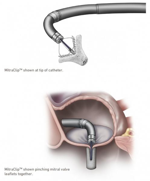 Graphic of MitraClip