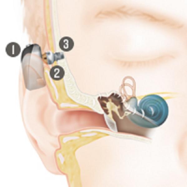 Bone anchored hearing system