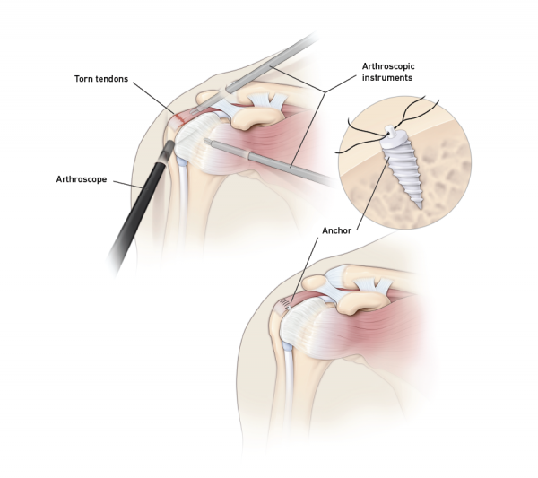 Damaged rotator cuff graphic