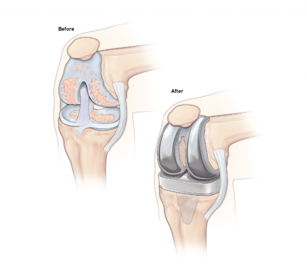 Knee replacement before and after graphic